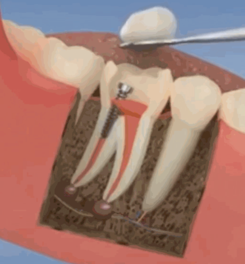 root canal animated gif